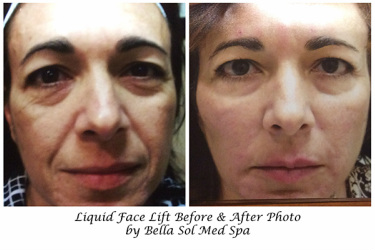 Bella Sol Liquid Face Lift Before & After Photos