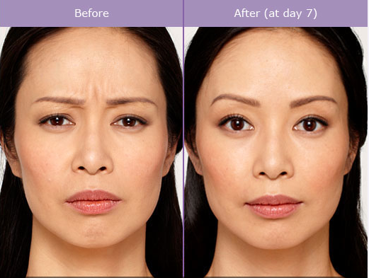 Botox Female Before & After Photos