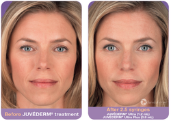 Juvederm Before & After Photo