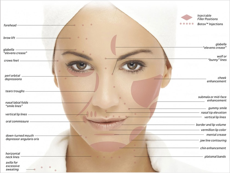 Where to Use Juvederm