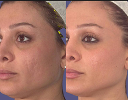 Pixel Skin Resurfacing Before & After