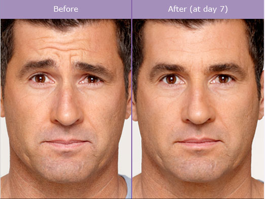 Male Botox Before & After